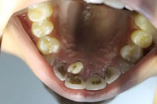 术前口内情况,一颗多生牙长于腭侧骨内可见