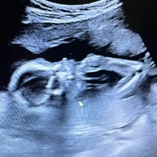 胎位低要注意什么