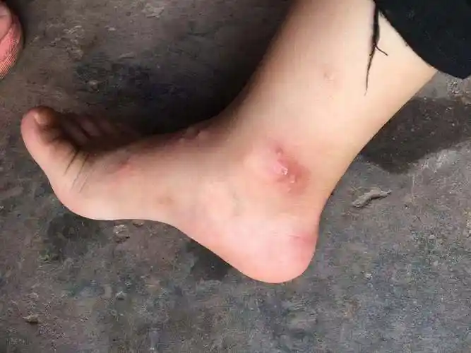 双脚出现红疹是不是病毒性疱疹