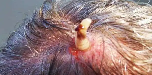 人皮蝇在活人身上产卵之后会怎么样