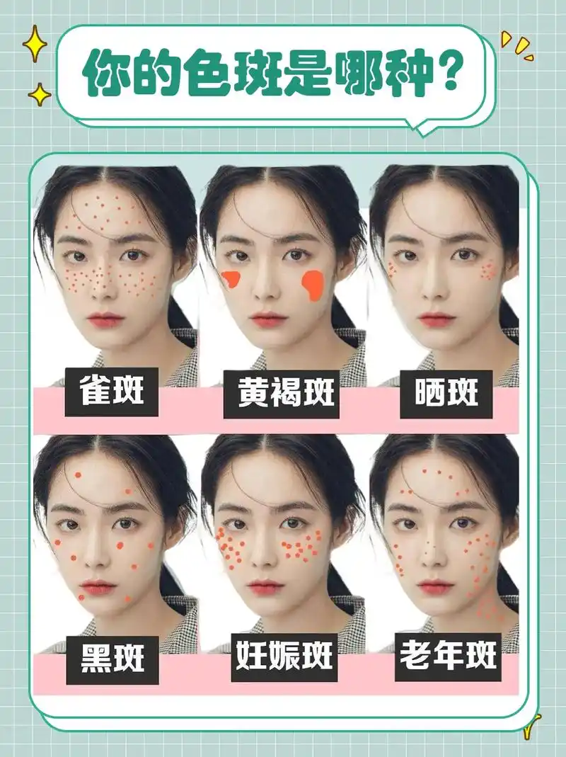 色斑大全分类.一起来了解你的皮肤吧#斑点#淡斑#长斑怎么办 - 抖音