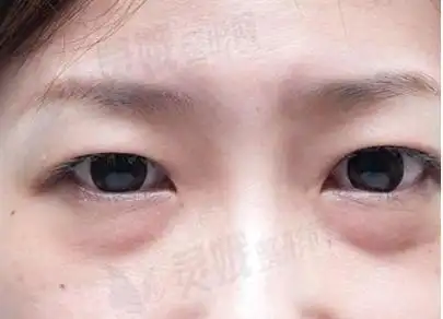 一,眼下眼睑下至对比图分享