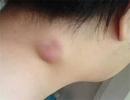 腋下淋巴肿大图片