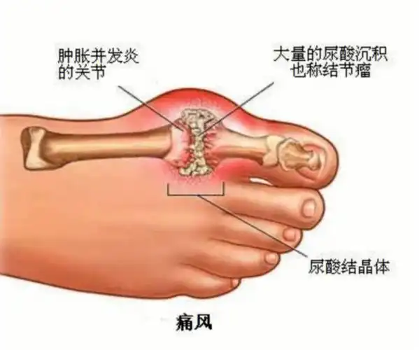 痛风为什么从脚开始疼原来和这些有关
