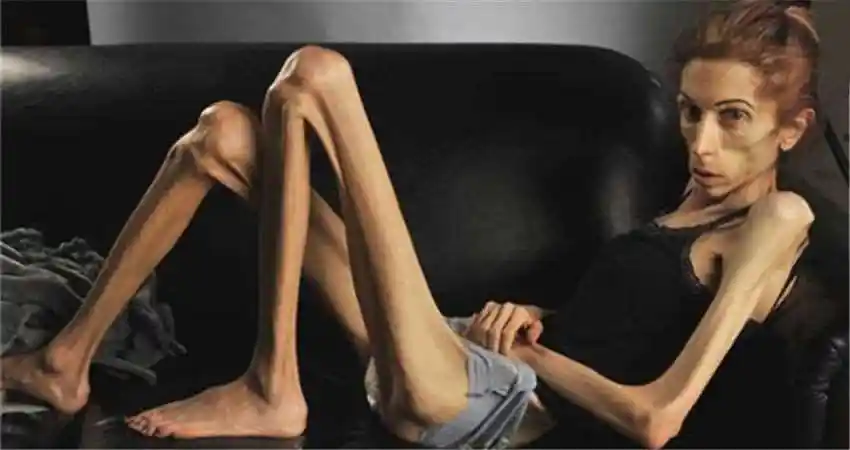 深受厌食症之苦的她瘦到只剩「18公斤」,连医生都束手无策,但在网友的