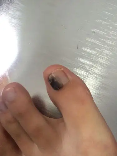 脚趾甲黑了一半,开始以为是淤血,已经两个多月了一直未消,不疼也不