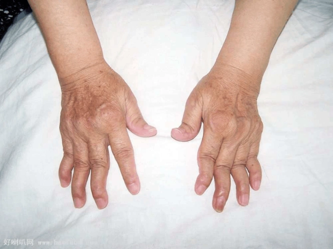 手痛风引起的关节变形能好吗