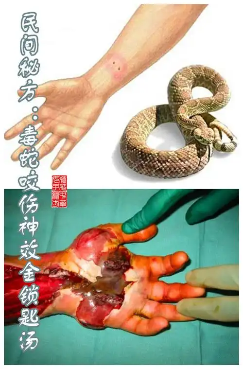 毒蛇咬伤民间秘方毒蛇咬伤神效金锁匙汤