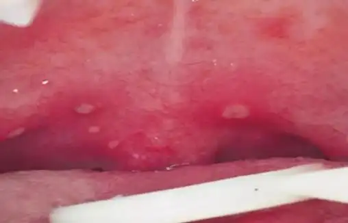 父母必知疱疹性咽峡炎是怎么一回事