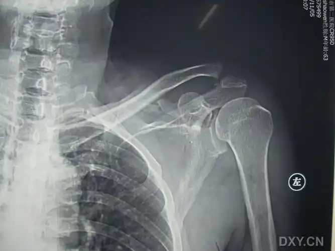 求助:这例肩锁关节脱位合并喙突骨折怎么手术入路?