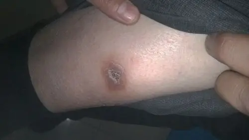 犬咬伤后伤口难以愈合