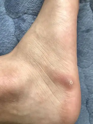 脚上起了一个硬包 一按就痛_百度知道