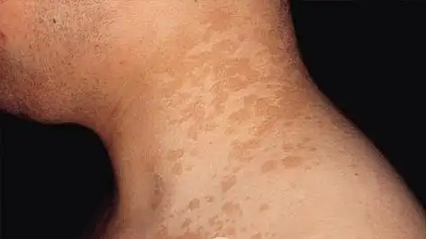 花斑糠疹的病因