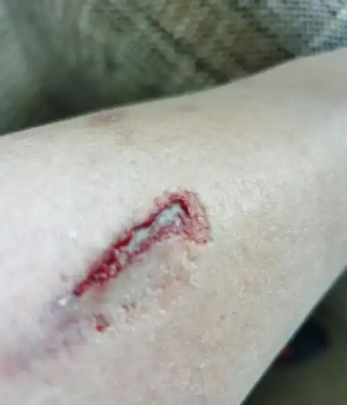 触目惊心于谦撞上汽车受伤照曝光腿部伤口隐隐露出骨头