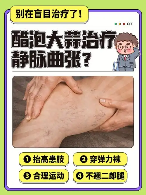 醋泡大蒜治疗静脉曲张?别再盲目治疗了!