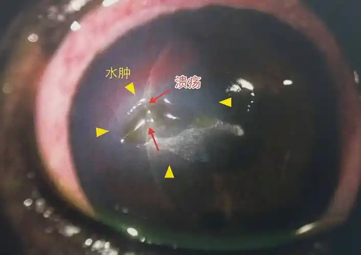 眼科科普 | 金刚砂车针在动物惰性角膜溃疡中的应用_治疗_上皮_and