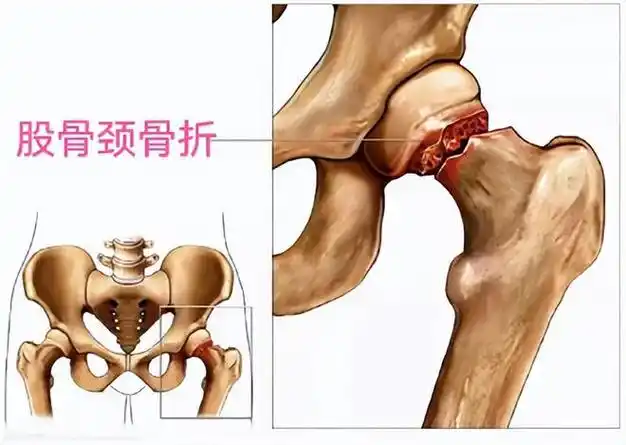 股骨颈骨折是指股骨头下至股骨颈基底部之间的骨折,是髋部最常见的