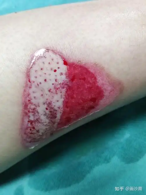 记录摩托车烫伤三度恢复过程 - 知乎