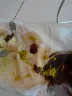 现从药物治疗变成了输液脓透明些