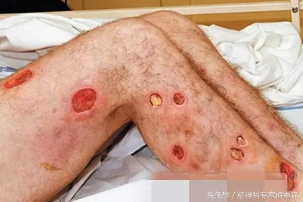 注射海洛因的危害有哪些?