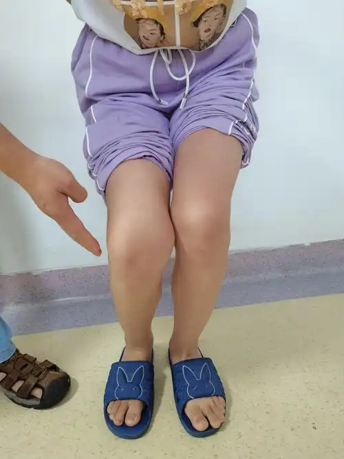 11岁女孩髌骨复发性脱位,手术治疗病例 - 好大夫在线