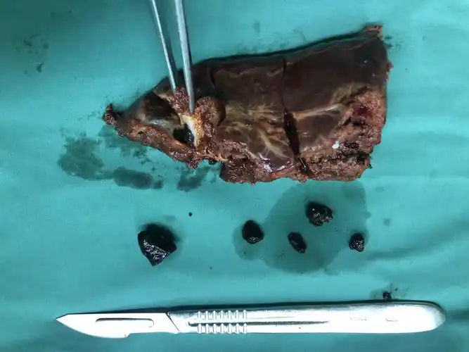 微创外科时代腹腔镜胆总管切开取石 5段肝切除治疗肝内外胆管结石