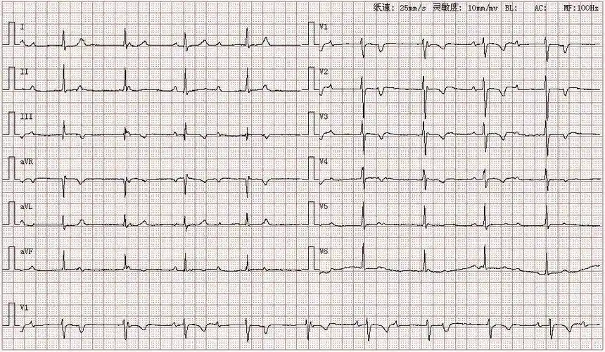 心电图库丨三度房室传导阻滞系列_心律_窦性_患者