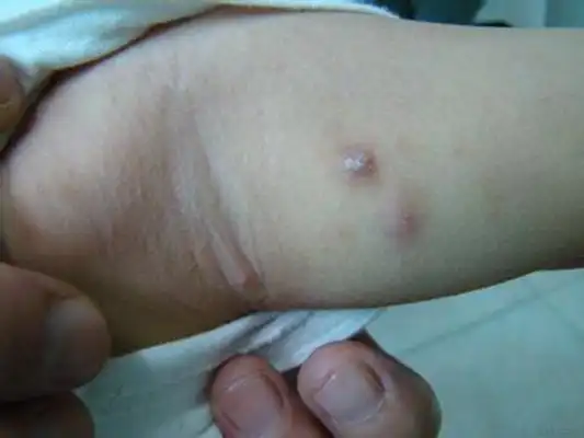 疥疮结节图片 (9)