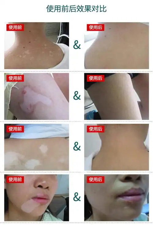 厂家直供欣佰沐康白斑抑菌液补骨脂白斑花斑汗斑白癜批发促黑色素