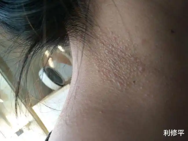 感染了phv:这种"小肉球"很多人身上都有,学会分辨可