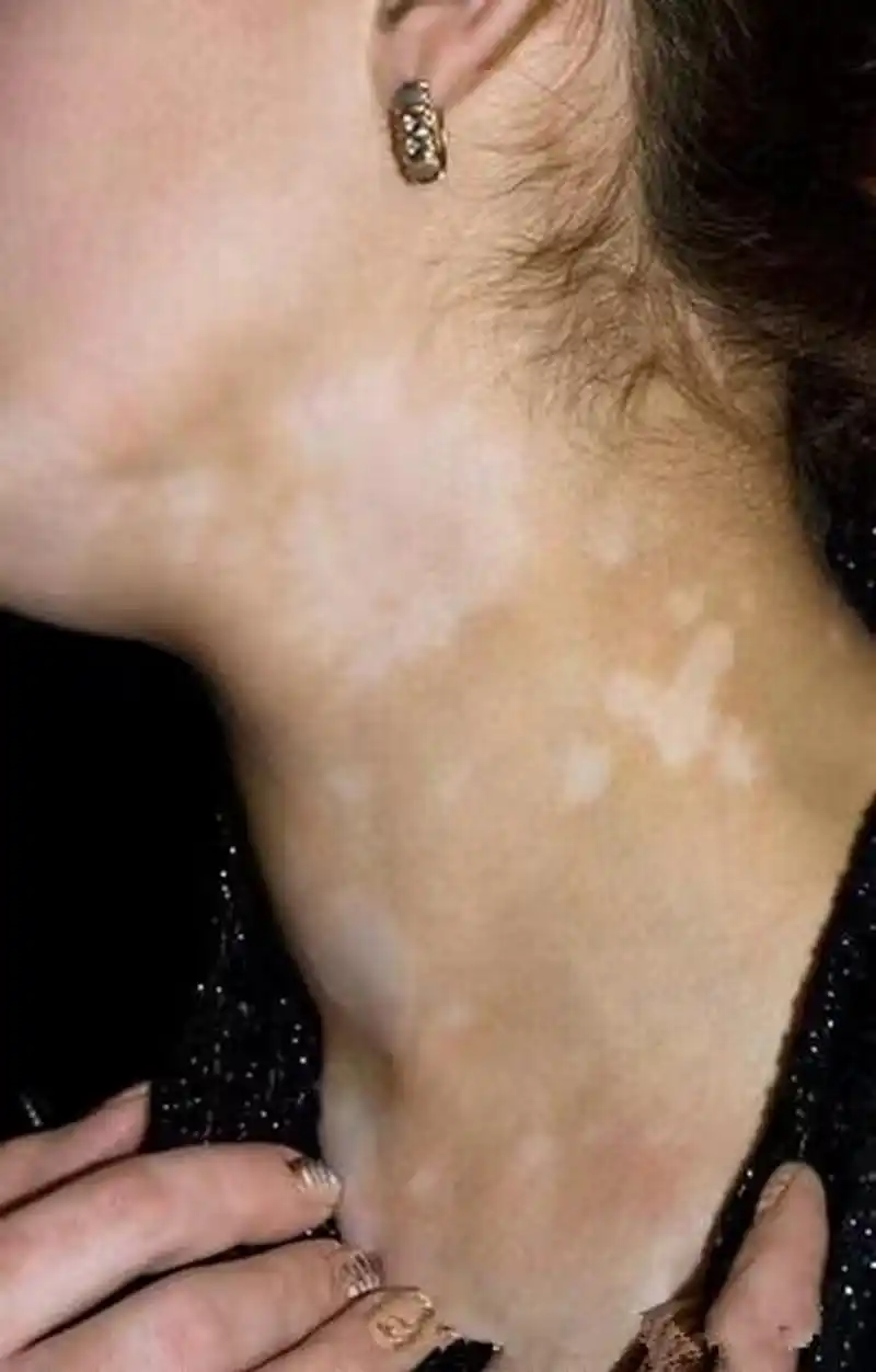 白色糠疹的临床症状:皮肤上出现边缘模糊的圆形或者椭圆形的淡红色的