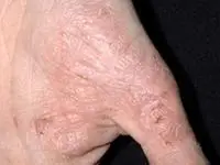 常见疾病 皮肤科 湿疹 湿疹样癌做手术多少钱?