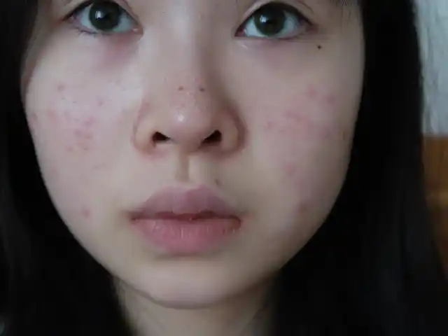 青春期痘肌女孩做可丽肤激光反馈