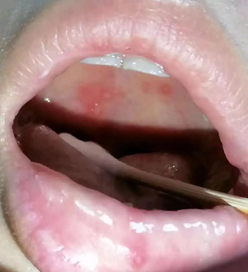 白塞病的口腔溃疡