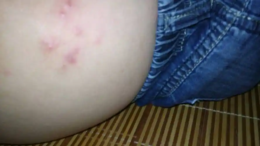 厦门皮肤病医院哪个比较好_厦门皮肤科较好的医院排名_厦门广肤医院