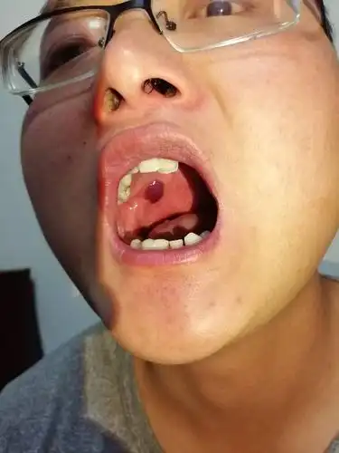 口腔里长了这个东西……是什么原因?
