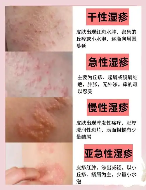 湿疹不用愁,轻松搞定!