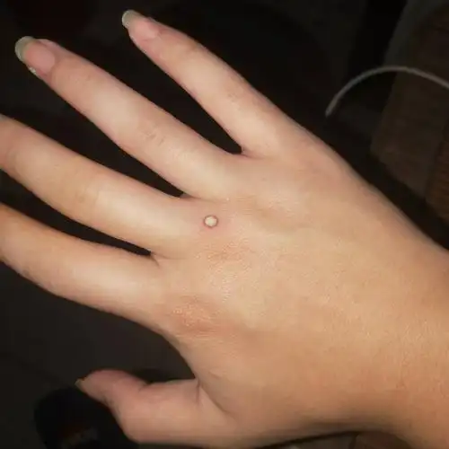 手掌背部张了个痘痘,一个多月了,也没看见消,求大神指教怎么弄掉他