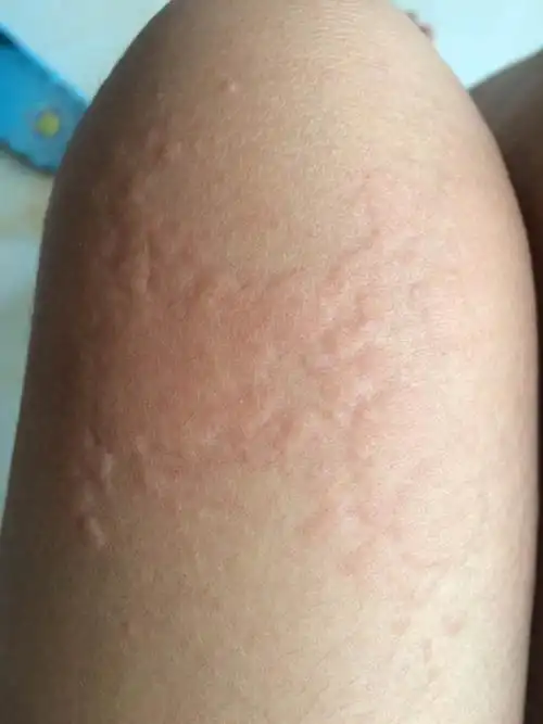 早上起床宝贝腿上起了好多大包,不知是过敏还是荨麻疹,奇痒无比,用