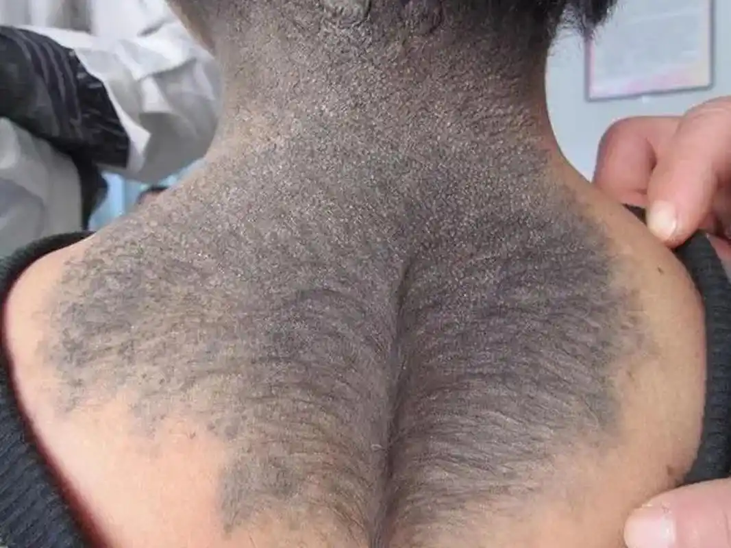 危险的兽皮痣,拖得越久越严重  兽皮痣小的象硬币大小,大可波及整个