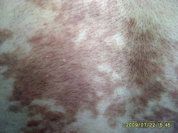 贝克尔痣(贝克尔黑变病)?