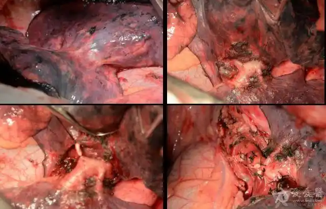 左肺上叶切除术