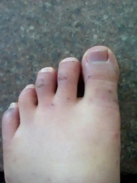 请问我的脚怎么了 都这样了 是冻疮吗?