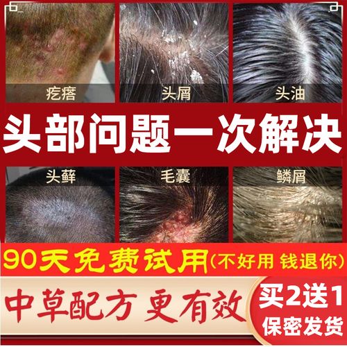 头皮癣专用药膏头皮屑癣治疗头部牛皮藓癣真菌感染银屑病外用药膏