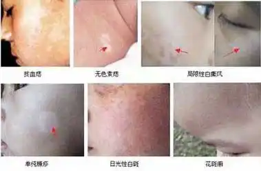 贫血痣等多种疾病混淆,临床可见有人被误诊为白癜风,结果错误治疗了