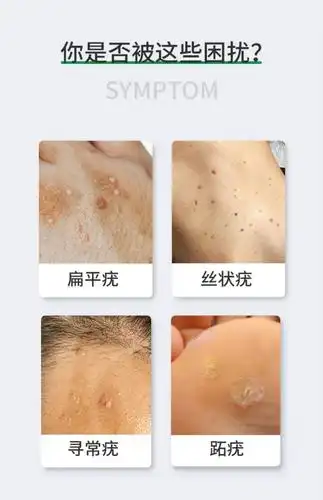 克尤康克疣液去猴子祛扁平丝状疣尖锐湿疣肉刺点痣膏腋下除皮赘5ml5g