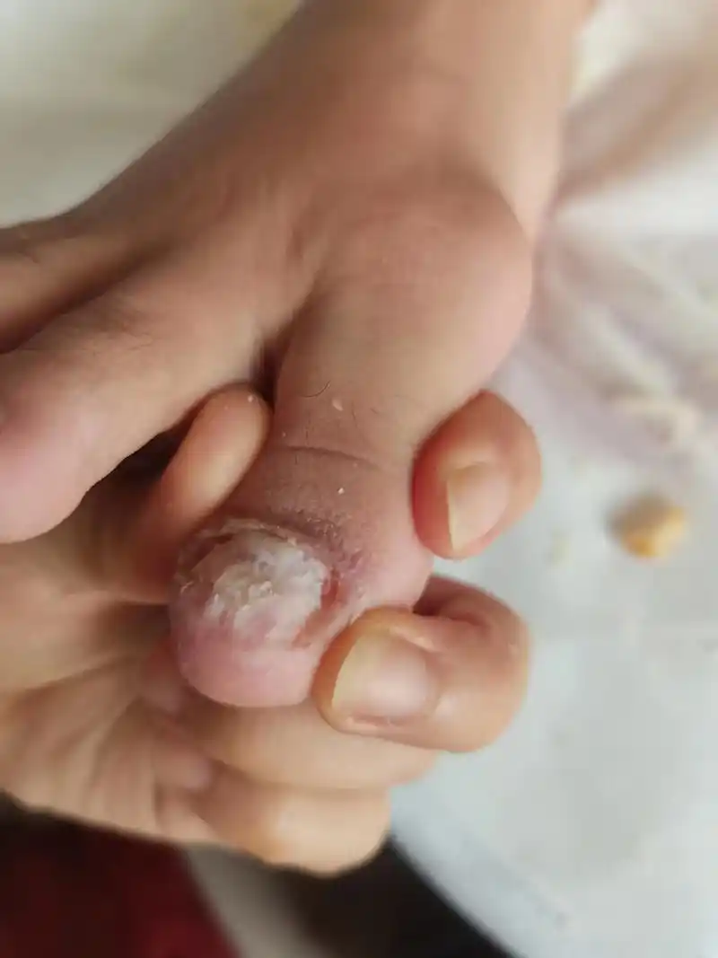 露脚季节到了,苦恼的灰指甲,七天脱甲的效果 - 抖音