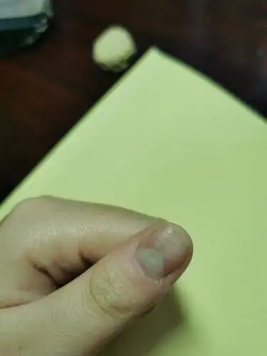 指甲有横纹,明显凹陷,用opi和nailtek可以改善嘛?感谢大家!