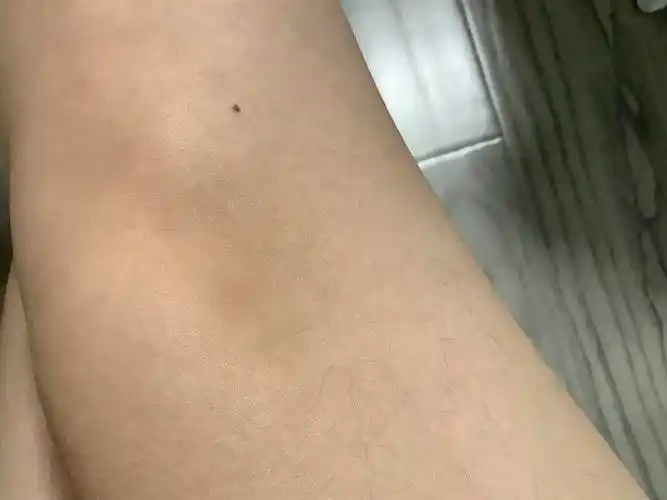 关于莫名其妙的腿部淤青