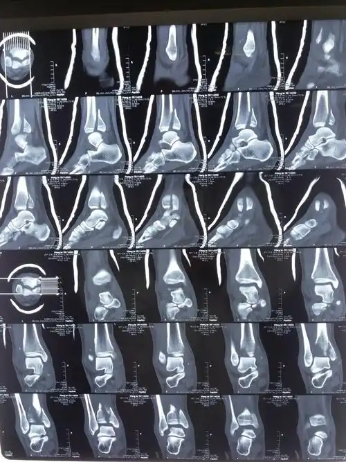 踝关节骨折病例